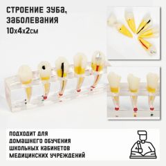 Макет «Строение зуба, заболевания», 10x4x2см