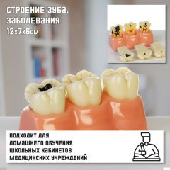 Макет «Строение зуба, заболевания», 12x7x6см