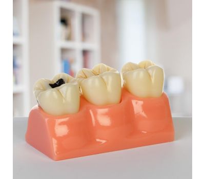 Макет "Строение зуба, заболевания": погрузитесь в мир анатомии!, изображение 4