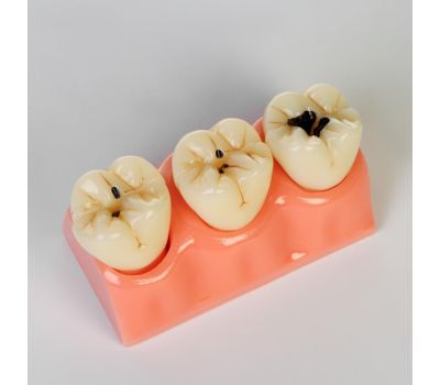 Макет "Строение зуба, заболевания": погрузитесь в мир анатомии!, изображение 2