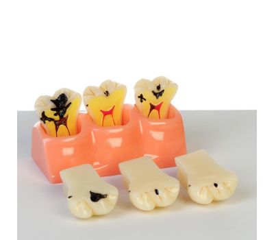 Макет "Строение зуба, заболевания": погрузитесь в мир анатомии!, изображение 3